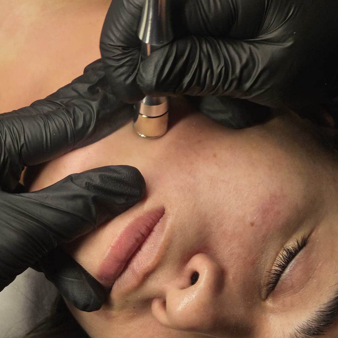 Microdermoabrasión